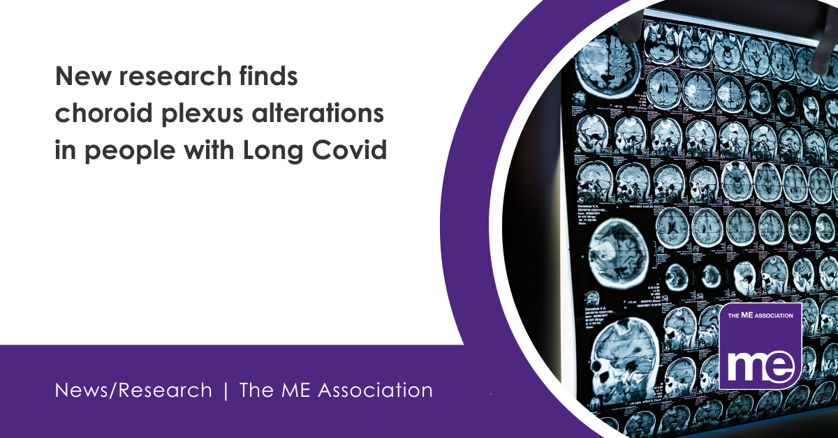 IMAGE DESCRIPTION: Photo of brain scans. Heading - New research finds choroid plexus alterations in people with Long Covid